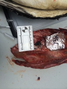 He had a large pre-mortem blood clot under his sternum on the left side of his body.